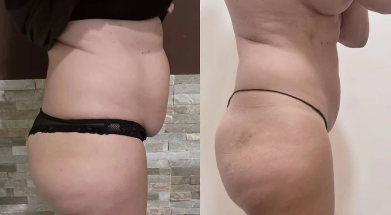 Antes y después de tratamiento de maderoterapia y drenaje, vista lateral