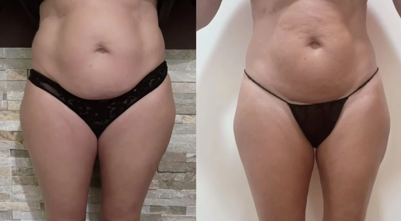 Antes y después de tratamiento corporal en abdomen, vista frontal
