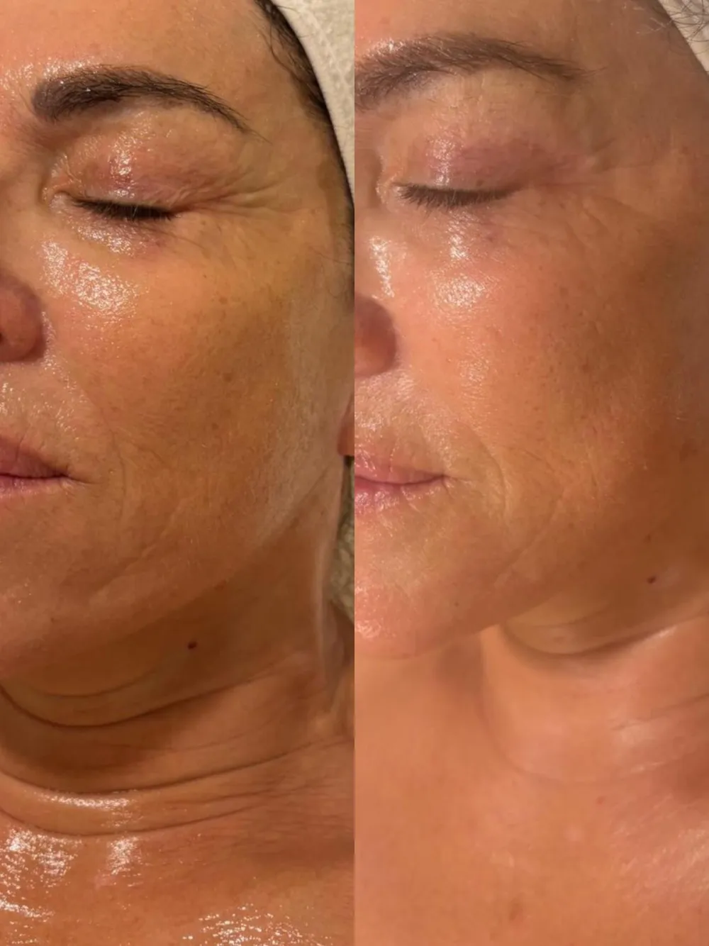 Antes y después de radiofrecuencia facial