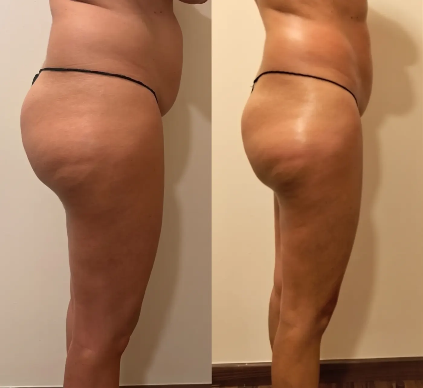 Antes y después de Rollaction y radiofrecuencia corporal, vista lateral